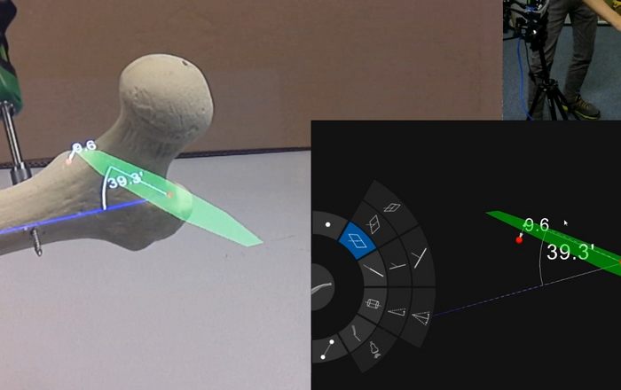 Das dreigeteilte Bild zeigt links den Blick durch die Augmented-Reality-Brille auf den Femur mit den Planungsdaten, rechts oben den Versuchsaufbau mit Brille und Femur und rechts unten die Darstellung der Planungsdaten am Monitor.