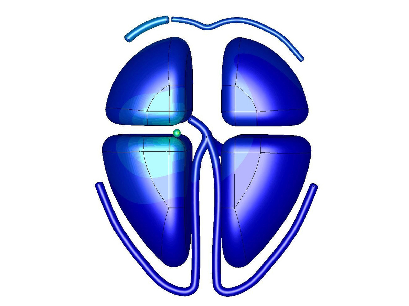 Eine Visualierung der elektrischen Aktivität des Herzens mit fokalen ventrikulären Tachykardien.