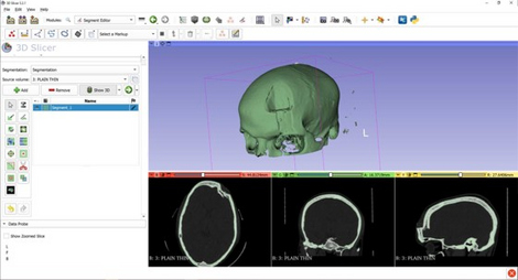 Segmentierung eines kranialen Defekts