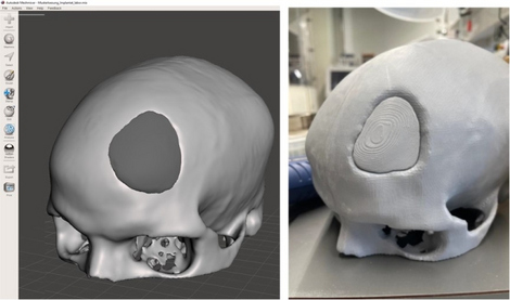 Konstruktion (links) und Druck (rechts) eines kranioplastischen Implantats