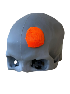 3D-gedrucktes Schädelmodell mit Implantat